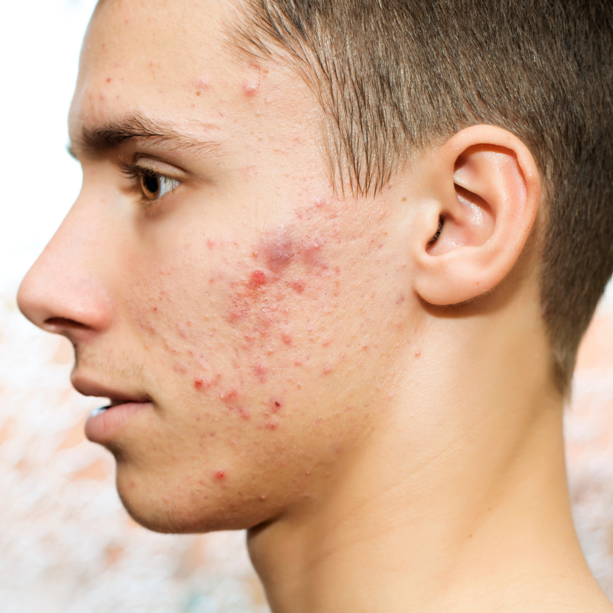 Nodulocystic Acne