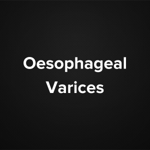 Oesophageal Varices