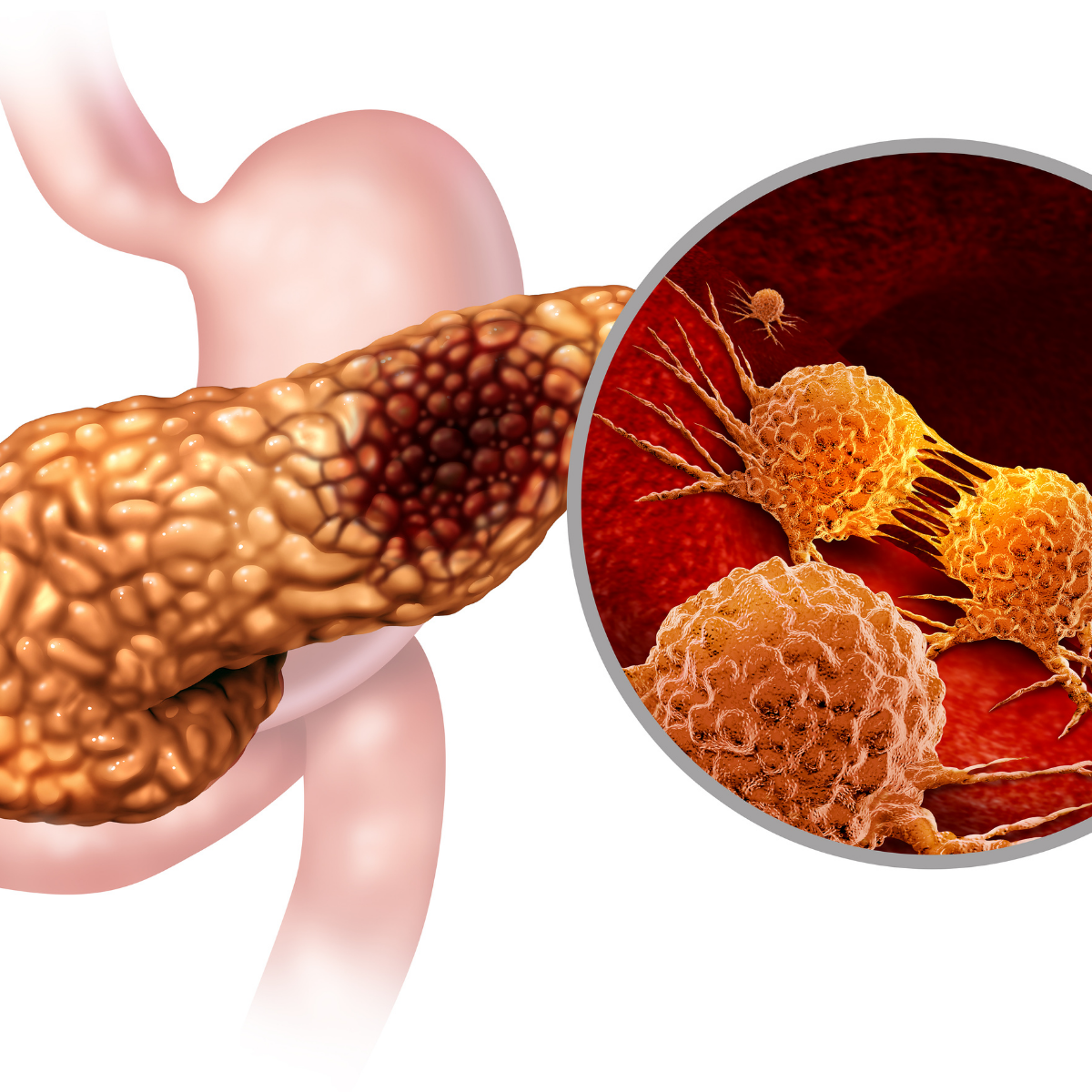 Pancreatic Cysts