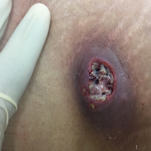 Perirenal Abscess
