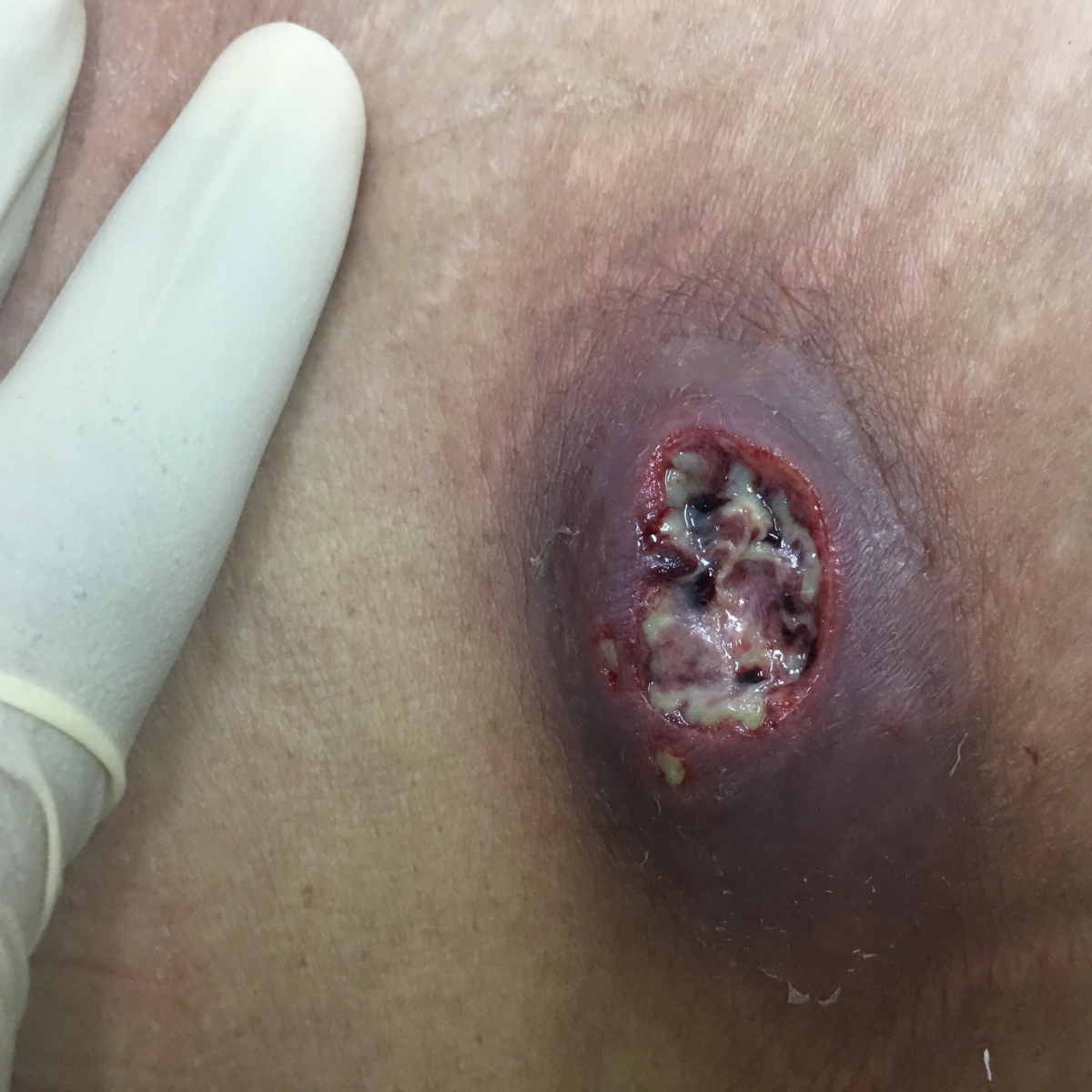 Perirenal Abscess