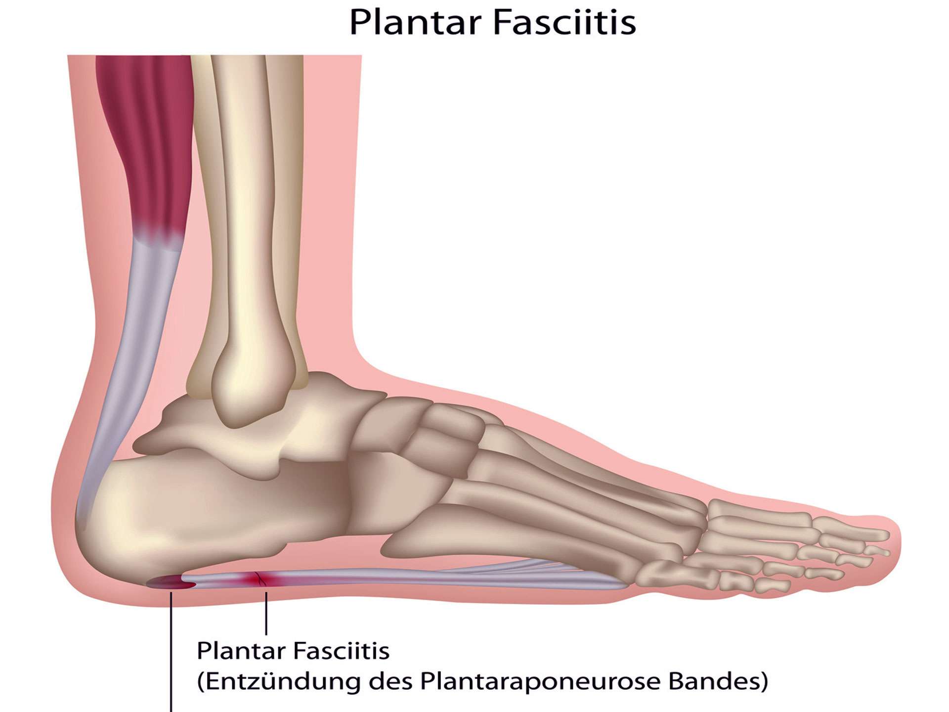 Plantar fasciitis – Common in overweight people