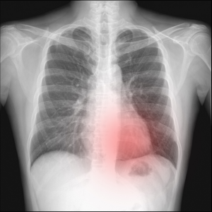 Pneumothorax