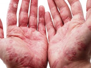 Psoriasis – Is your psoriasis worse in winter?