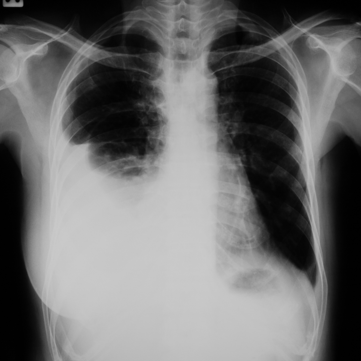 Pulmonary edema