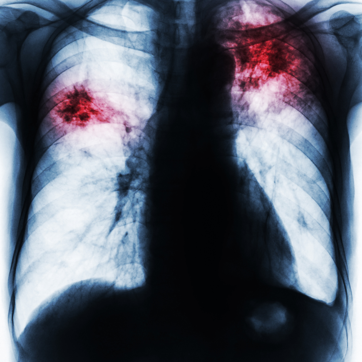 Pulmonary embolism