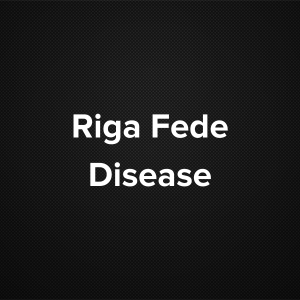 Riga-Fede Disease