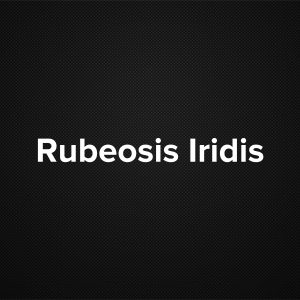 Rubeosis Iridis