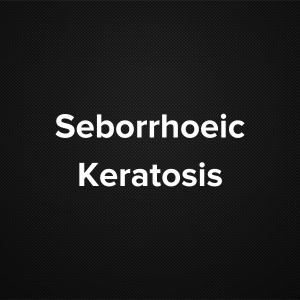 Seborrhoeic Keratosis (Seborrheic Verruca, Senile Wart)