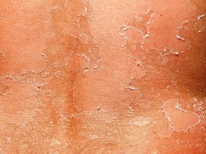 Summer woes – Skin troubles and remedies