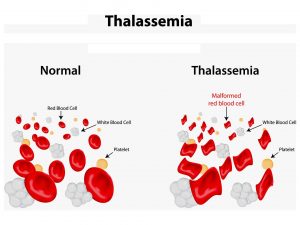 Thalassemia – When your anemia is inherited