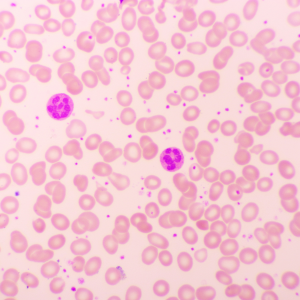 Thrombocytosis