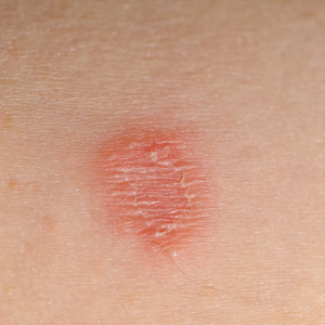 Tinea Corporis (Ringworm Infection, Dermatophytosis)