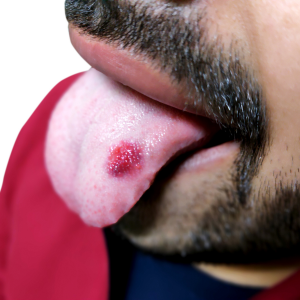 Tongue Cancer