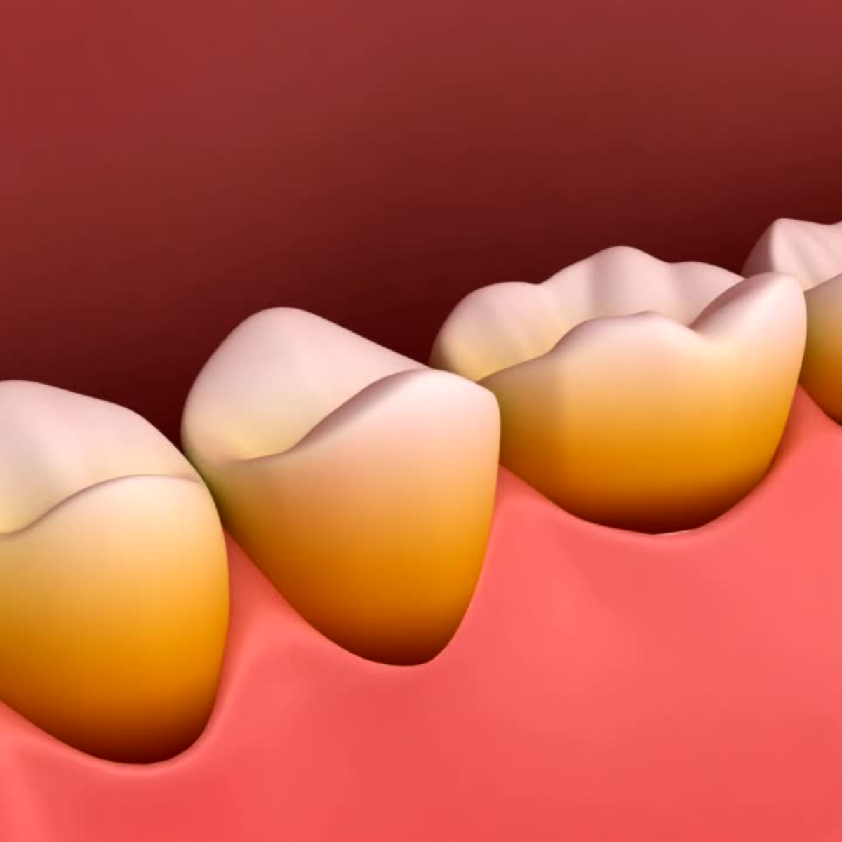 Tooth Discoloration