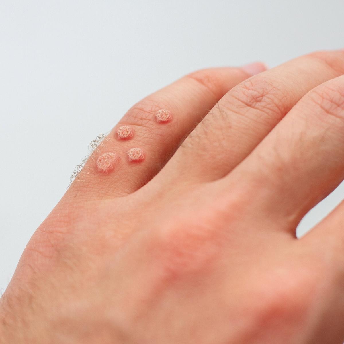 Viral Warts