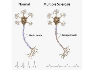 Vitamin D and multiple sclerosis