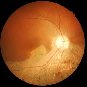 Wet macular degeneration