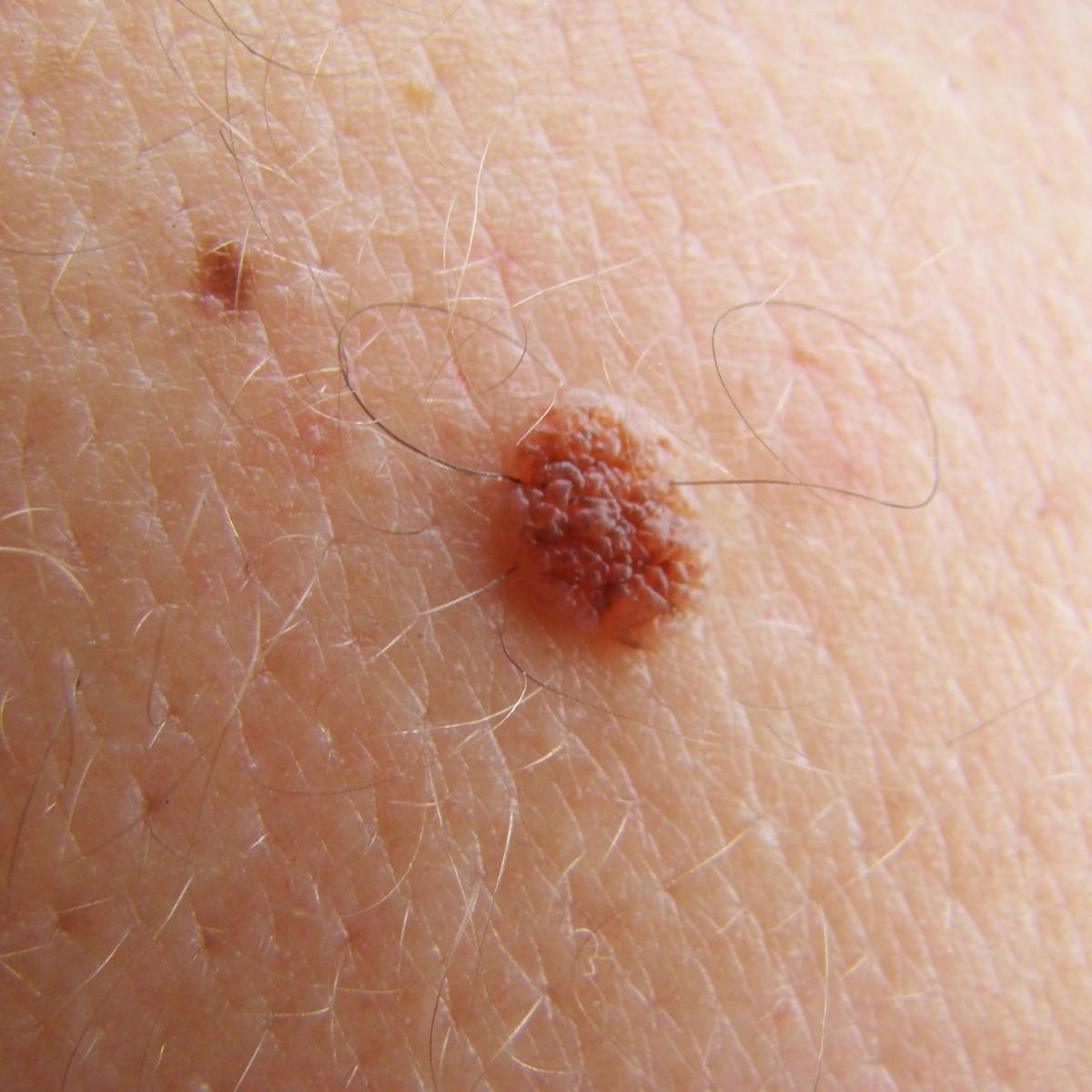 White sponge nevus