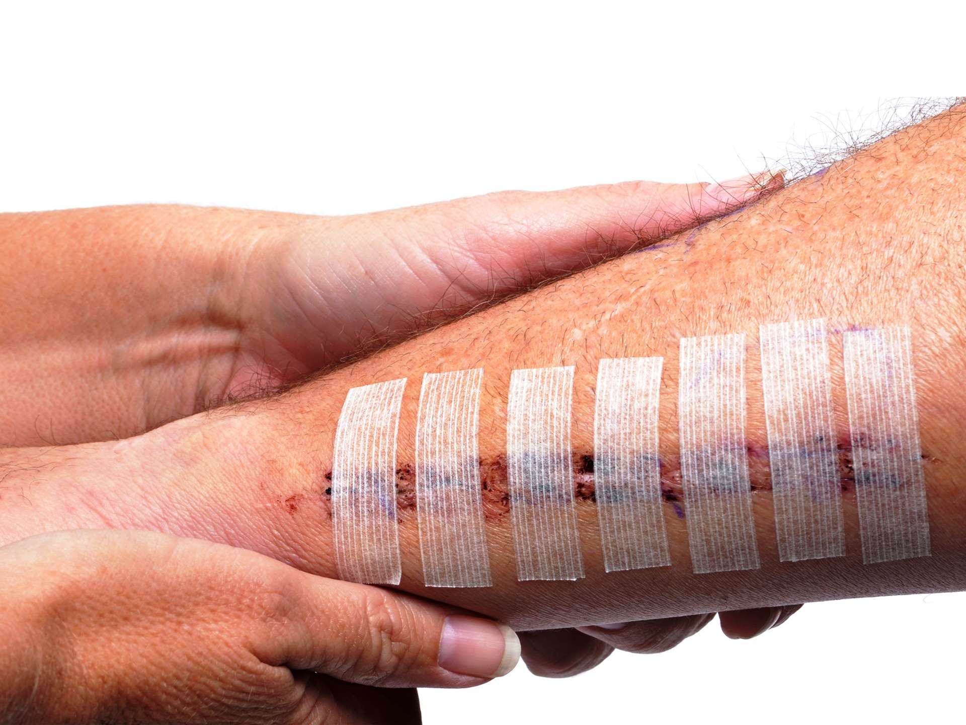 Wound care myths and facts