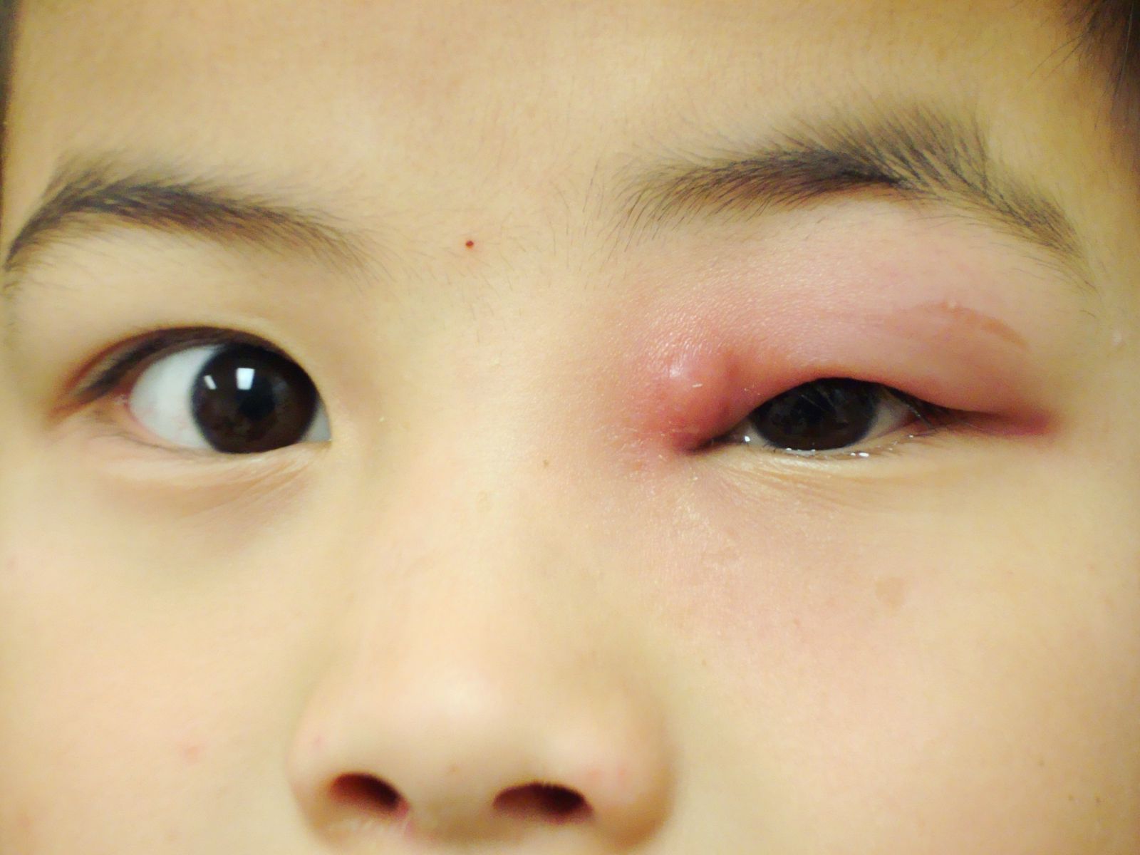 Acute dacryocystitis