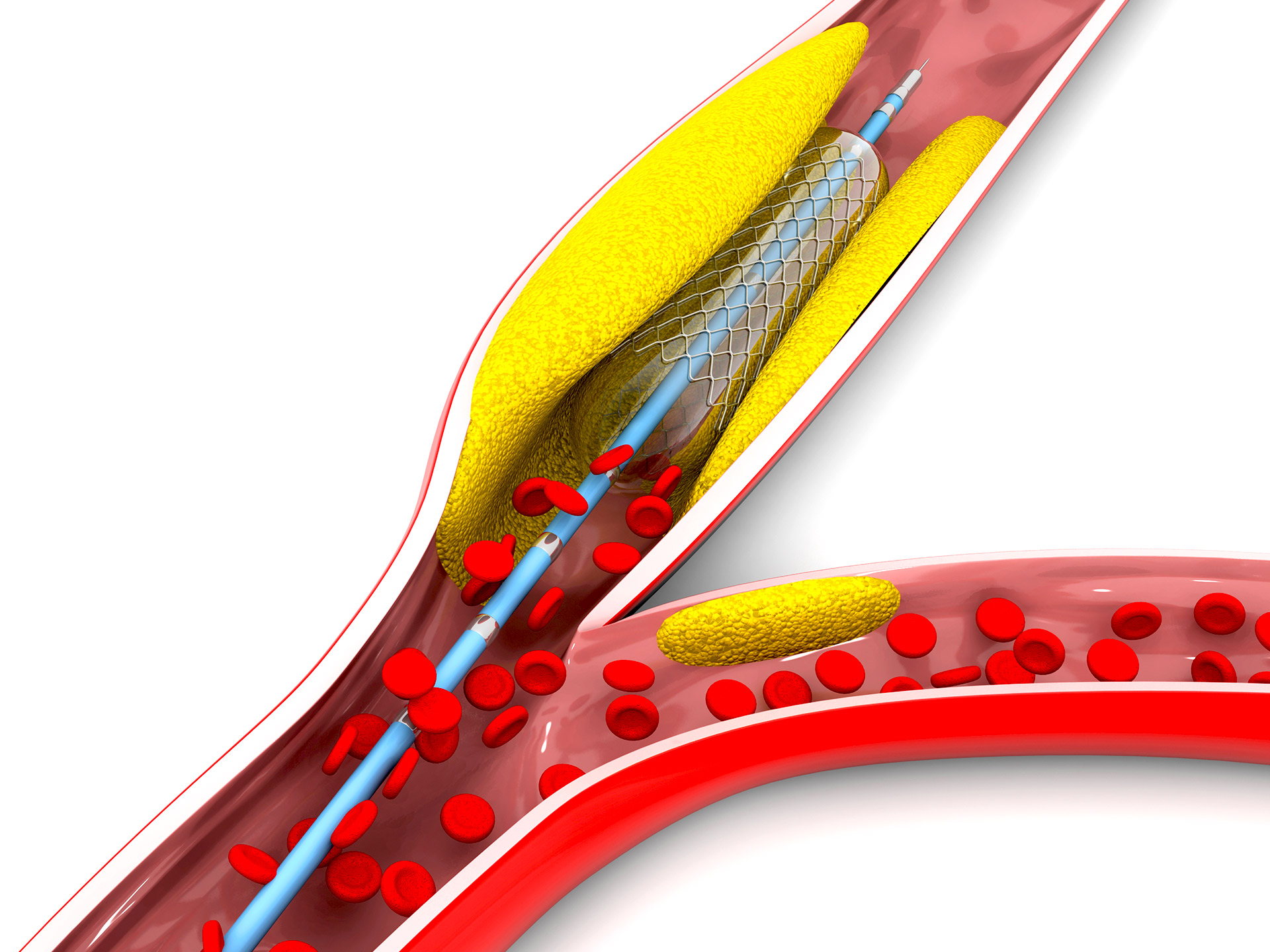 An Interview with Dr. Shirish Hiremath on Angioplasty