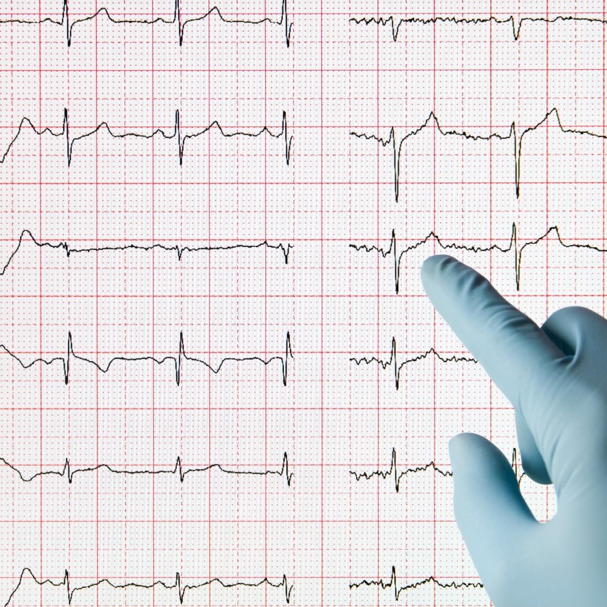 Ventricular septal defect