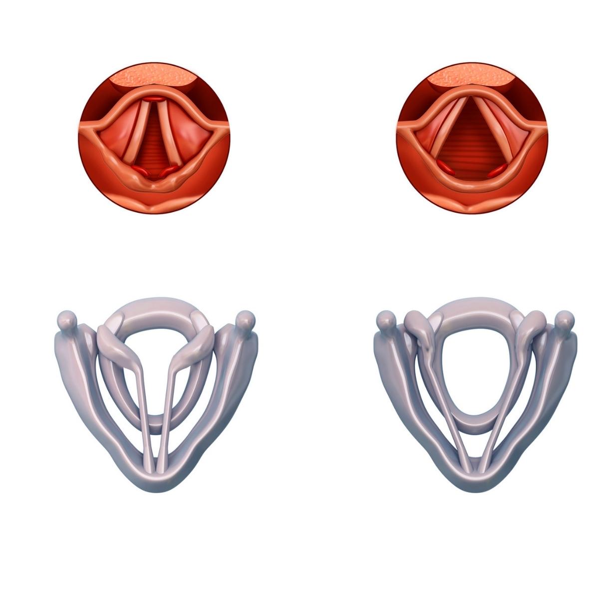 Vocal cord paralysis