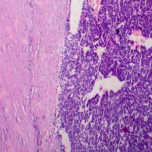 Wilms tumor (Nephroblastoma, Kidney cancer)