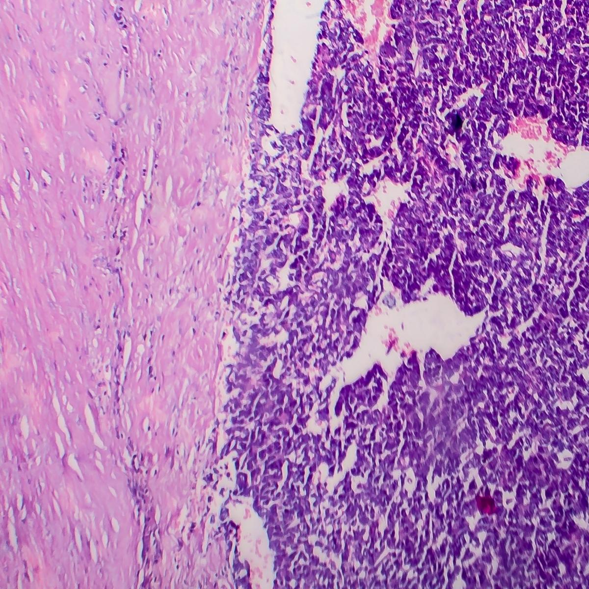 Wilms tumor (Nephroblastoma, Kidney cancer)