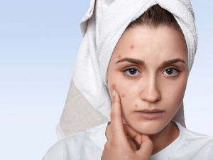 Acne: myths and facts