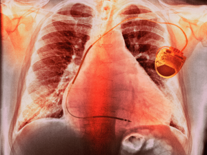 Management of Chronic Obstructive Pulmonary Disease