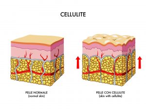 All about cellulite