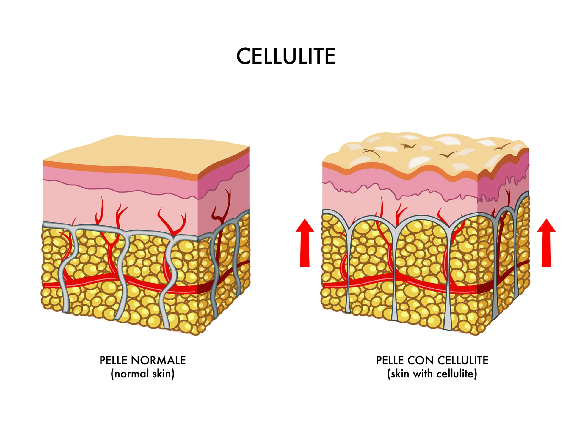 All about cellulite